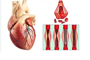 آنژیوگرافی