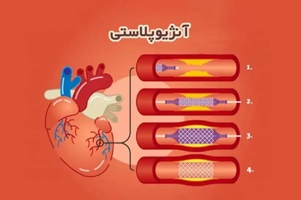 آنژیوپلاستی