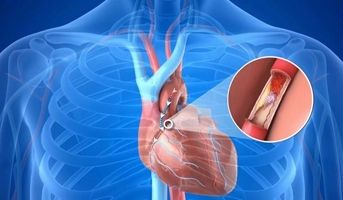 مراقبت های بعد از جراحی قلب 