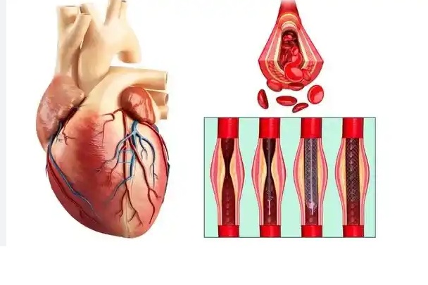 آنژیوگرافی