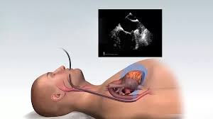 اکوکاردیوگرافی از مری